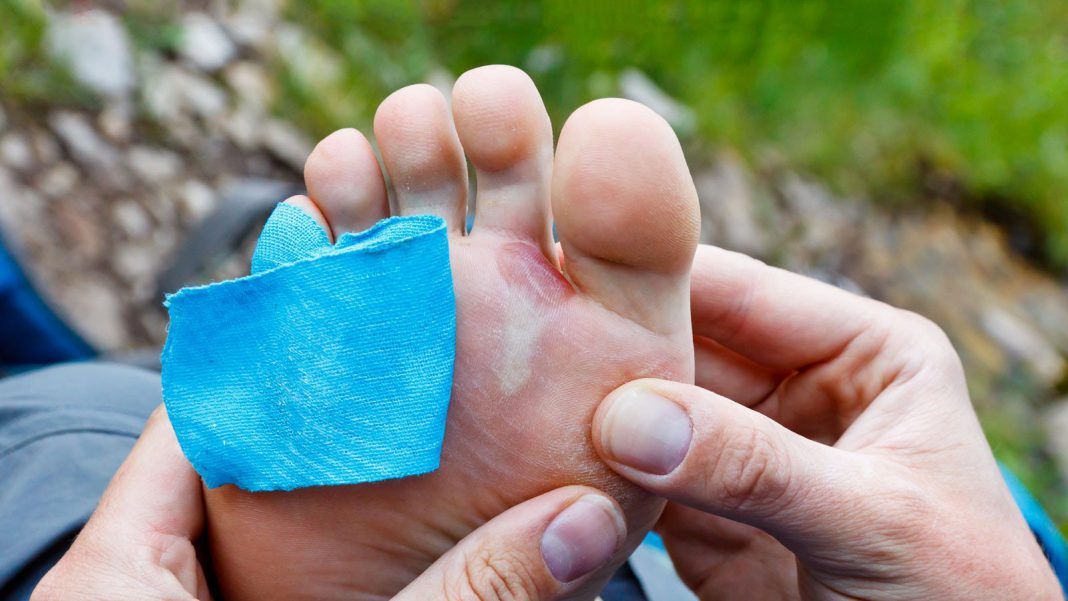 Blisters from worn running shoes